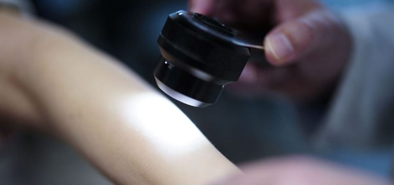 Krankenkasse: Zunahme von Hautkrebsdiagnosen