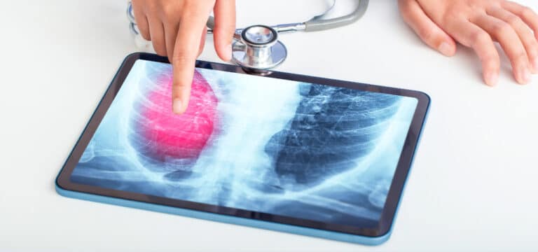 Tuberkulose: Eine anhaltende Bedrohung – auch in Deutschland?